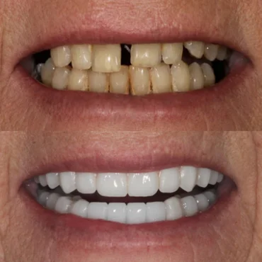 Before and after dental implants