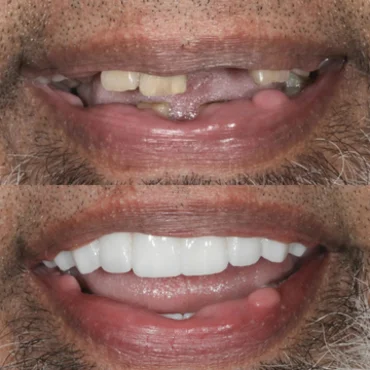 Before and after dental implants