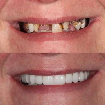 Before and after dental implants
