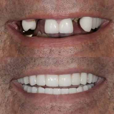 Before and after dental implants