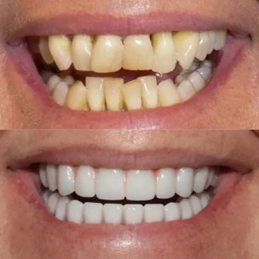Before and after dental implants