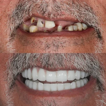 Before and after dental implants