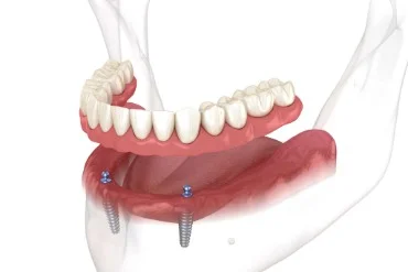 Implant-supported overdenture