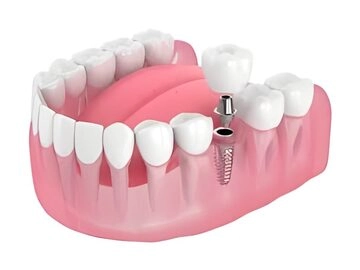 Single dental implant