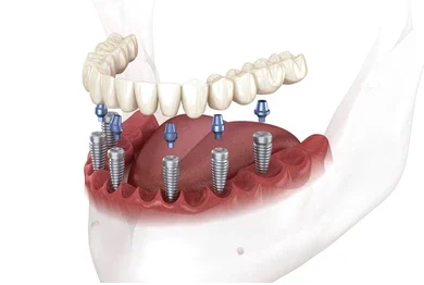 All-on-X full arch implants